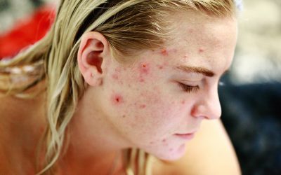 Sem cicatrizes! Você não precisa sofrer com o monstro da acne