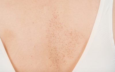 Entenda o jeito [certo] de tratar o melasma