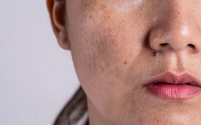“Mas que mancha é essa?” Entenda o que é o melasma
